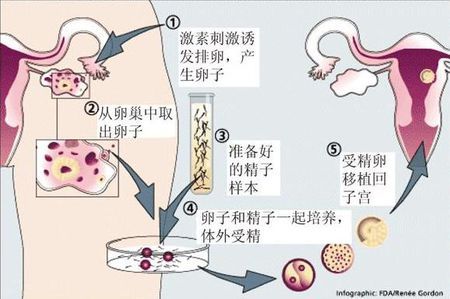 着床前診断 PGT